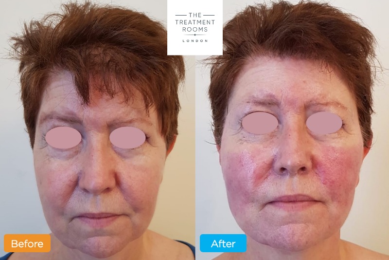 Non-Surgical Face Lift
